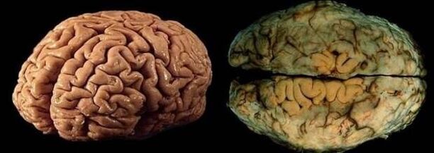 мозок здорового і питущого людини